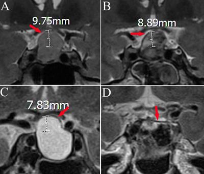 Predictive factors for delayed hyponatremia after transsphenoidal surgery in patients with Rathke’s cleft cysts